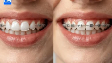 ارتودنسی شفاف بهتر است یا سیمی؟