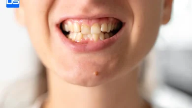 مال_اکلوژن (Malocclusion)