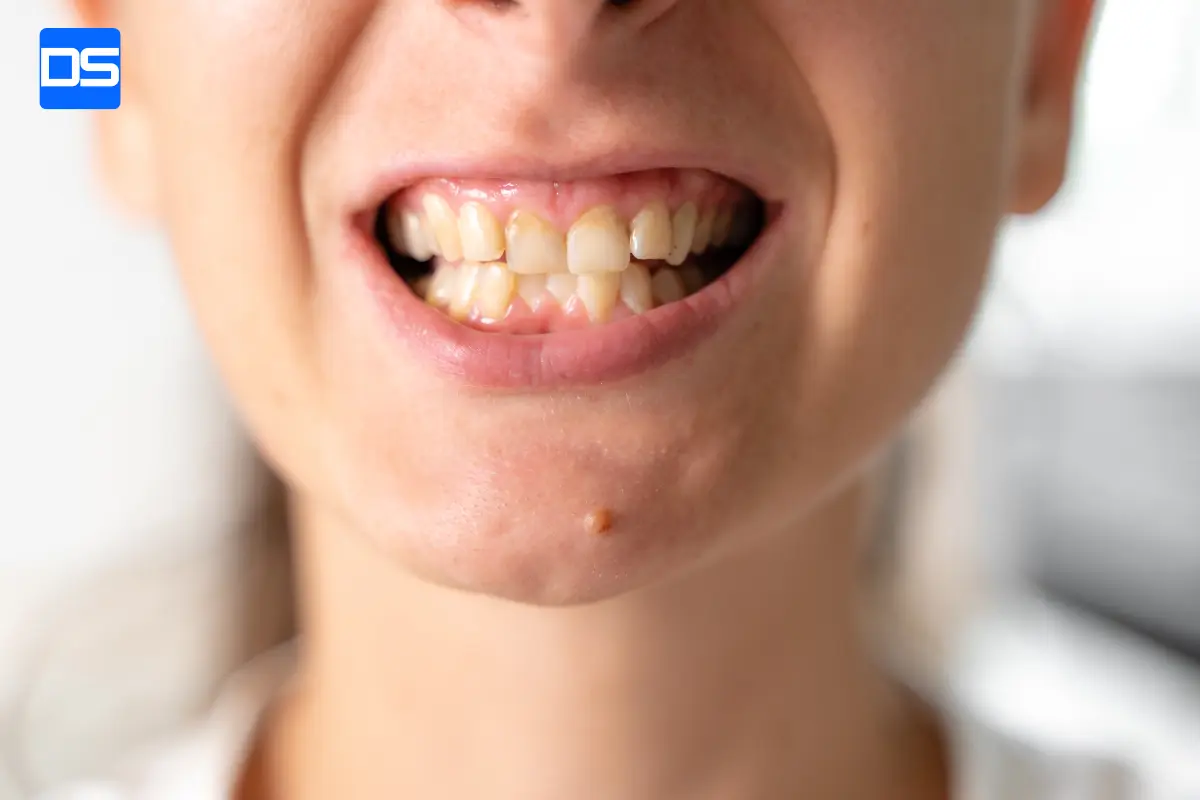 مال_اکلوژن (Malocclusion)