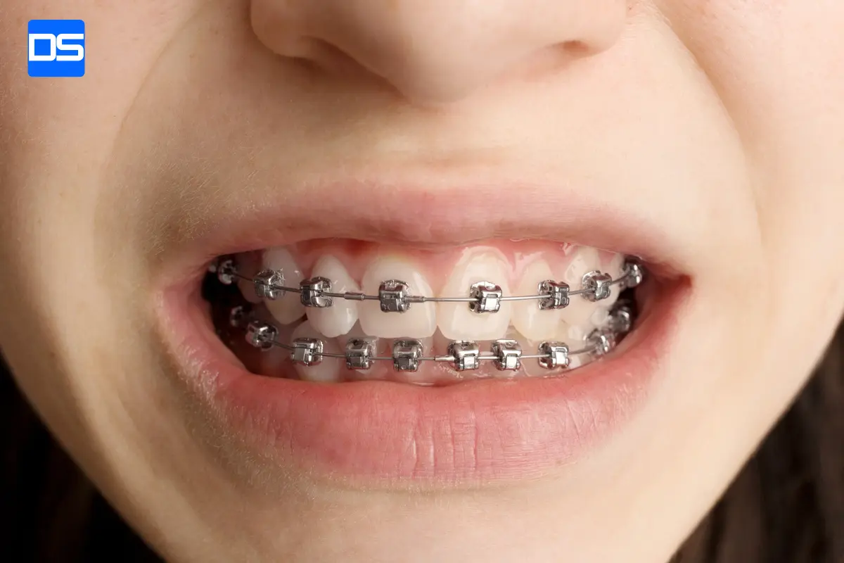 مال_اکلوژن (Malocclusion) درمان با ارتودنستی