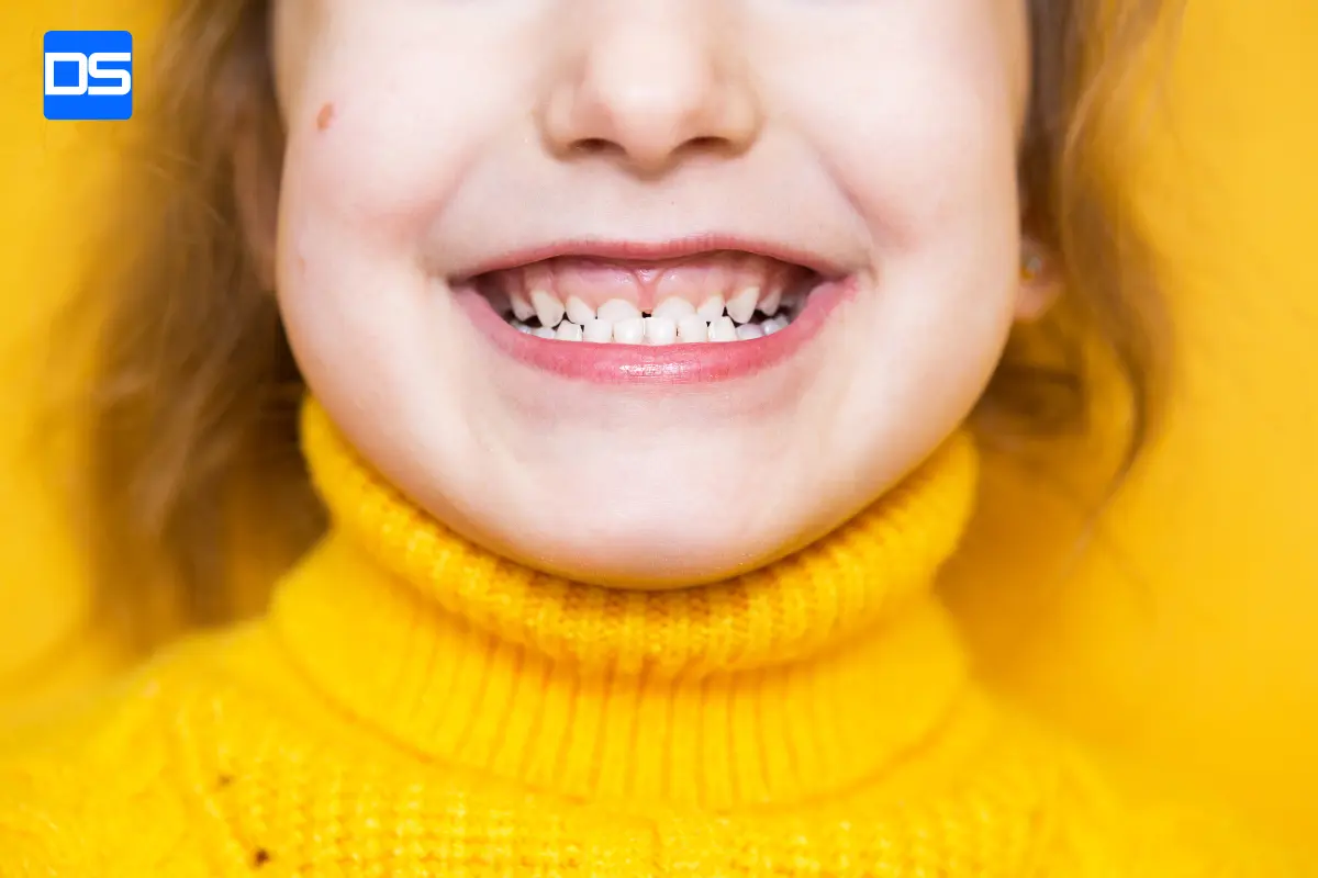 مال_اکلوژن (Malocclusion)عقب رفتگی فک نوعی