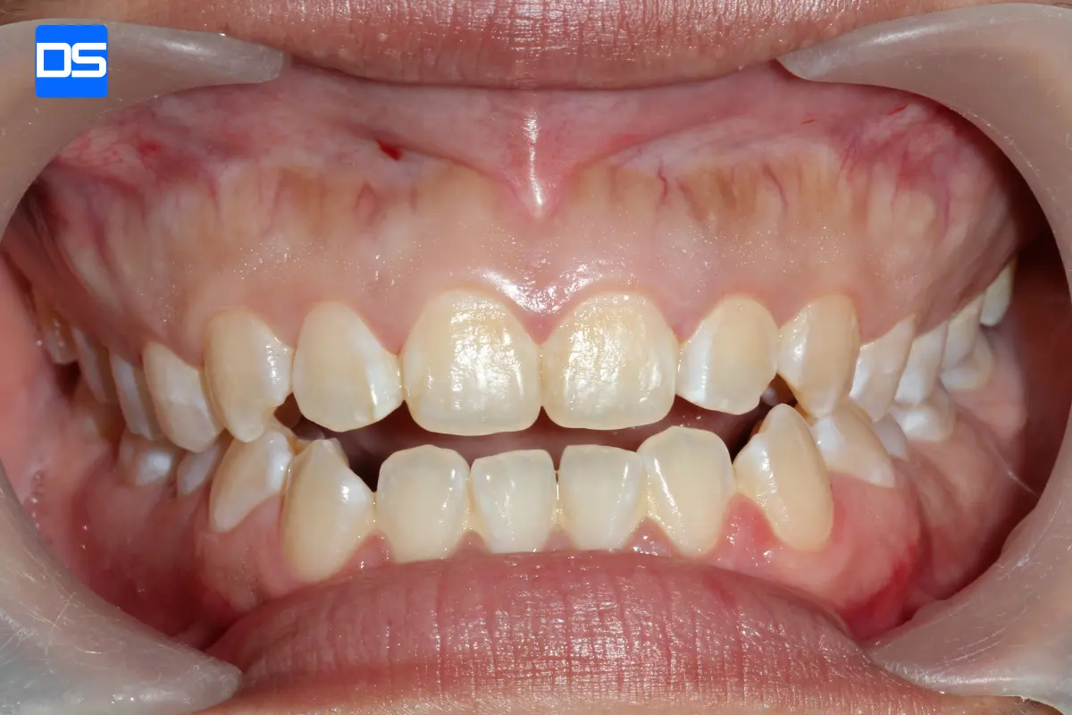 نمونه مال_اکلوژن (Malocclusion) خفیف با فاصله بین دندانی