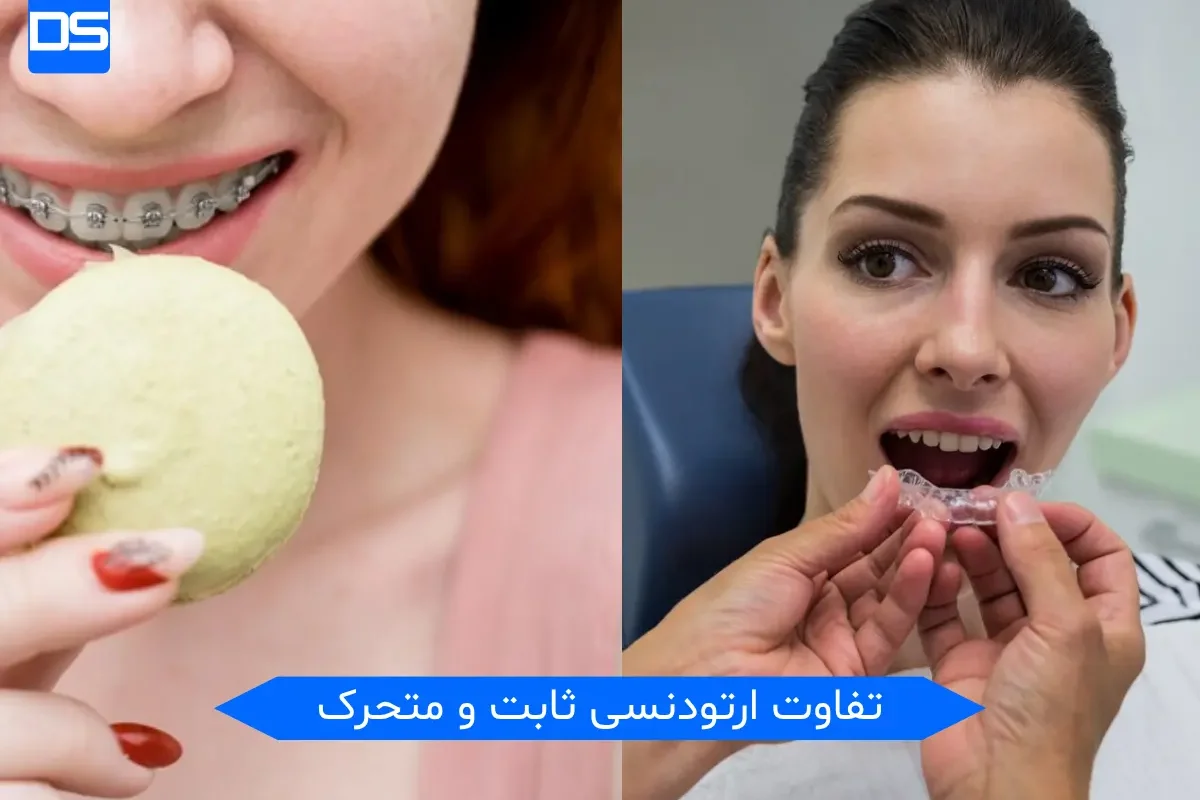تفاوت ارتودنسی ثابت و متحرک